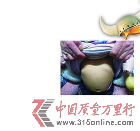 在“聲討金奇仕”的QQ群里，一位媽媽發的自己寶寶肋骨外翻的照片。