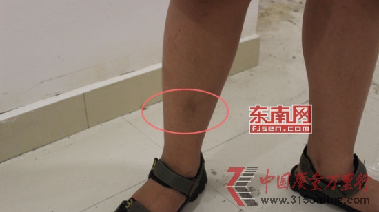 12歲男孩噴云南白藥氣霧劑后長(zhǎng)出2厘米黑毛 12歲男孩噴云南白藥氣霧劑后長(zhǎng)出2厘米黑毛